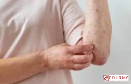 kasus dokter Cianjur meninggal campak