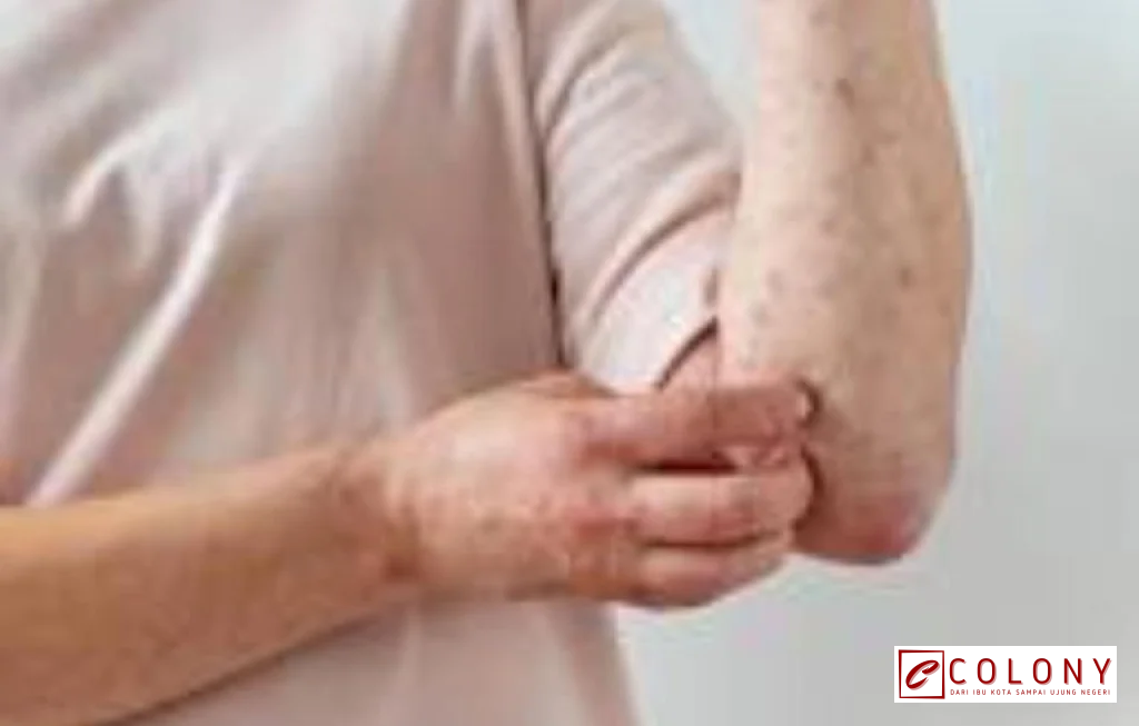 kasus dokter Cianjur meninggal campak